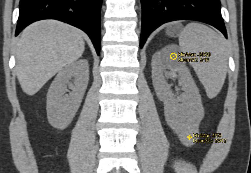 Papillary Cell Renal Cell Carcinoma Left Kidney - CTisus CT Scan