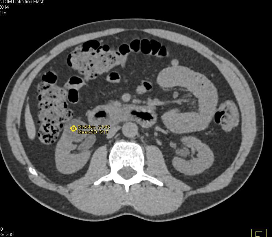 Papillary Cell Renal Cell Carcinoma Left Kidney - CTisus CT Scan