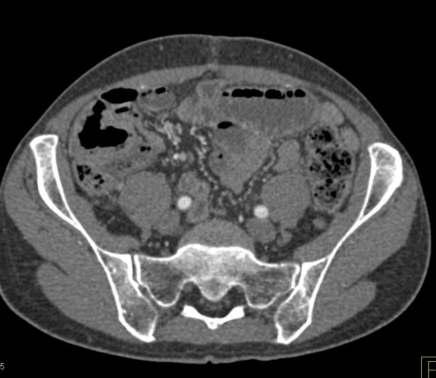 Transitional Cell Carcinoma of the Right Renal Pelvis - CTisus CT Scan