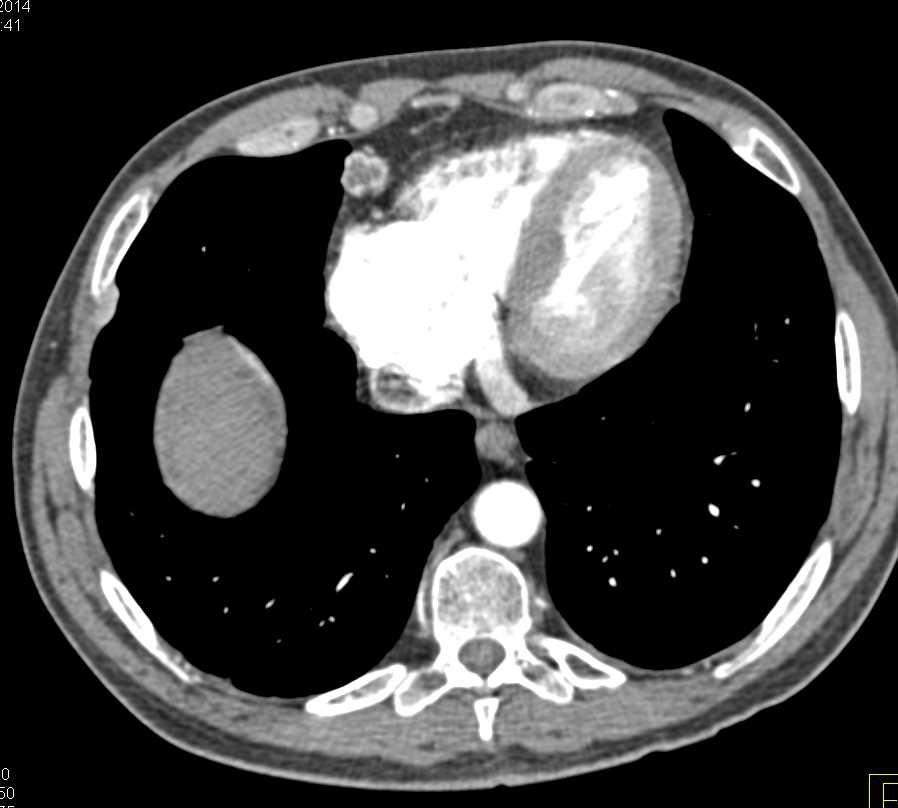 Metastatic Renal Cell Carcinoma to Paracardiac Region and Pancreas - CTisus CT Scan