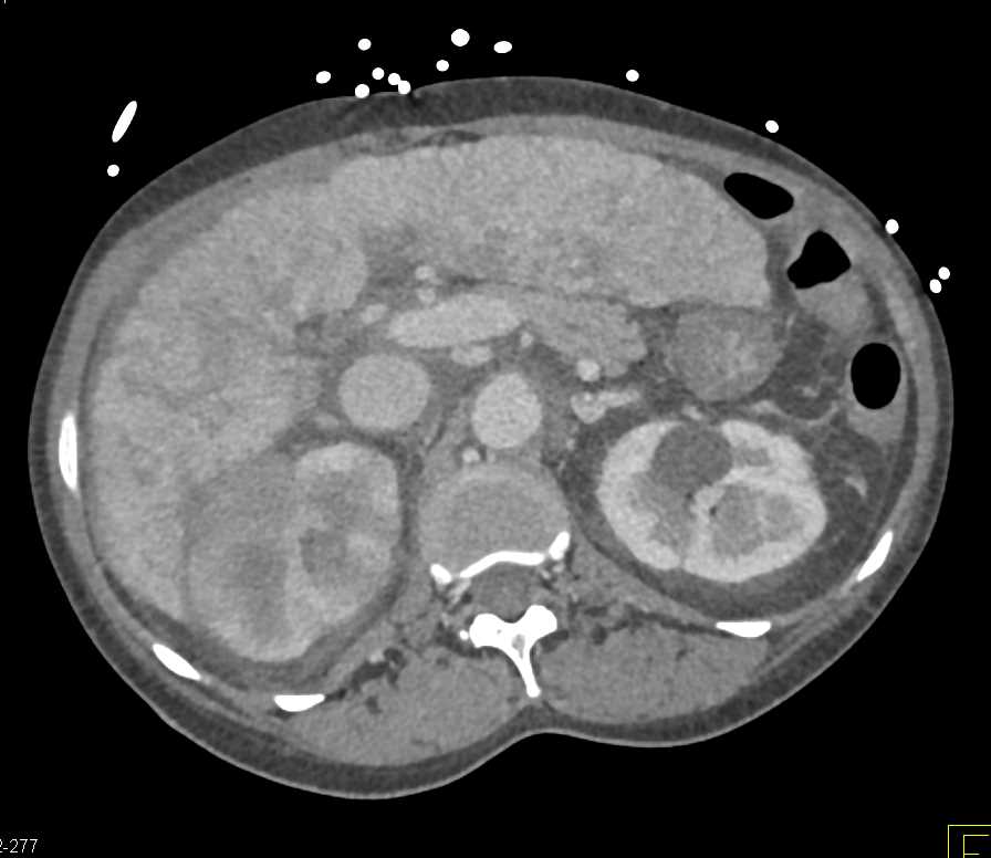 Lymphoma Infiltrating the Right Kidney - CTisus CT Scan