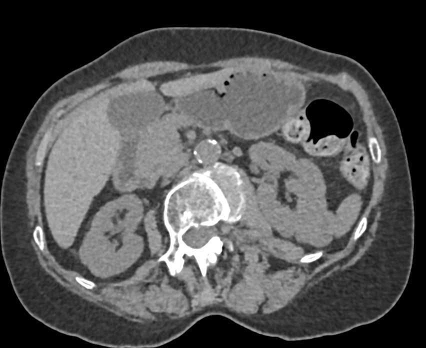 Papillary Carcinoma Lower Pole Left Kidney - CTisus CT Scan