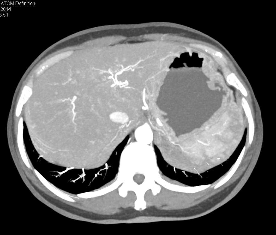 Metastatic Neuroendocrine Tumor To the Liver - CTisus CT Scan