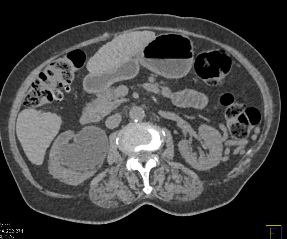 Transitional Cell Carcinoma of the Right Renal Pelvis and Ureter - CTisus CT Scan