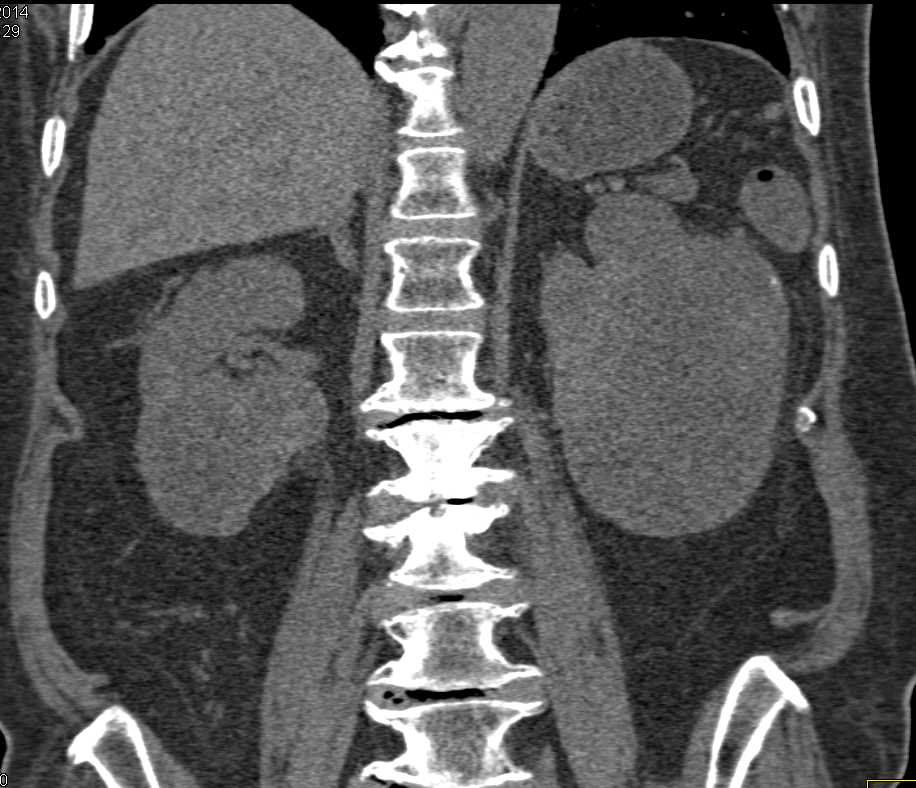 Cystic Renal Cell Carcinomas - CTisus CT Scan