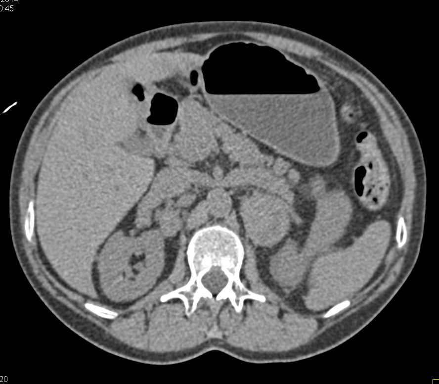 Cystic Renal Cell Carcinoma with Left Adrenal Metastases - CTisus CT Scan