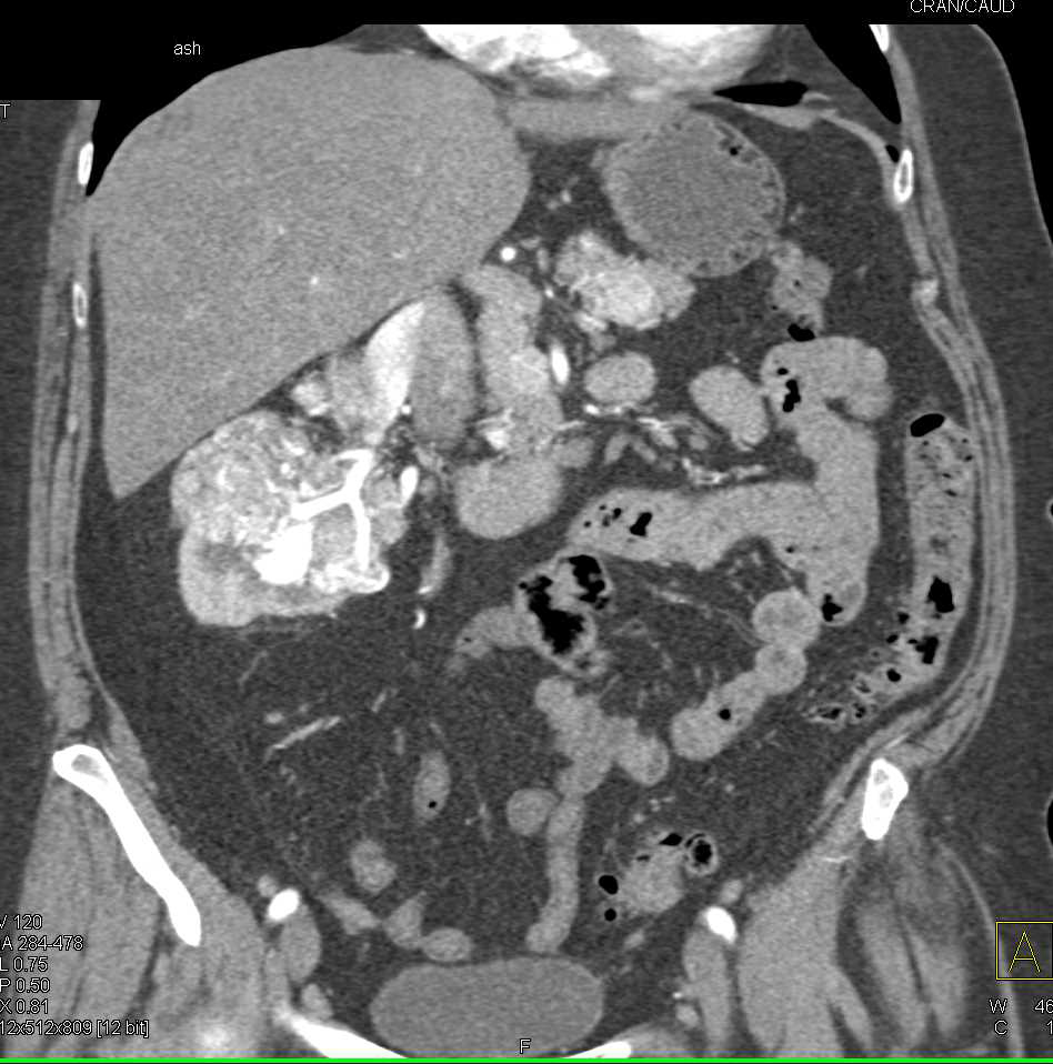 Vascular Renal Cell Carcinoma was a Clear Cell Renal Cell Carcinoma - CTisus CT Scan