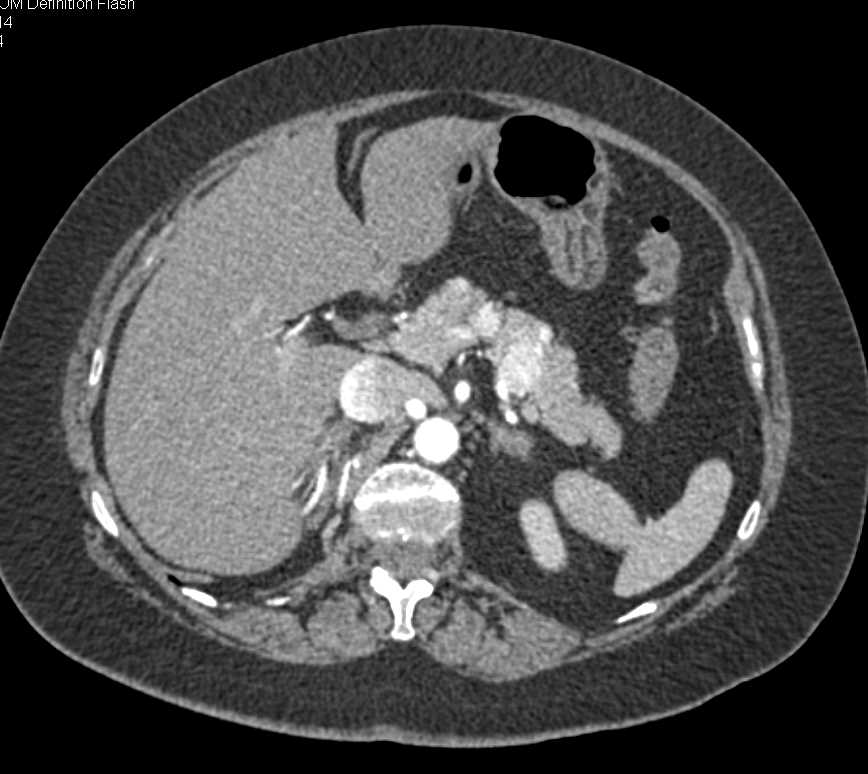 Metastatic Renal Cell Carcinoma to Contralateral Kidney, Liver and Pancreas - CTisus CT Scan