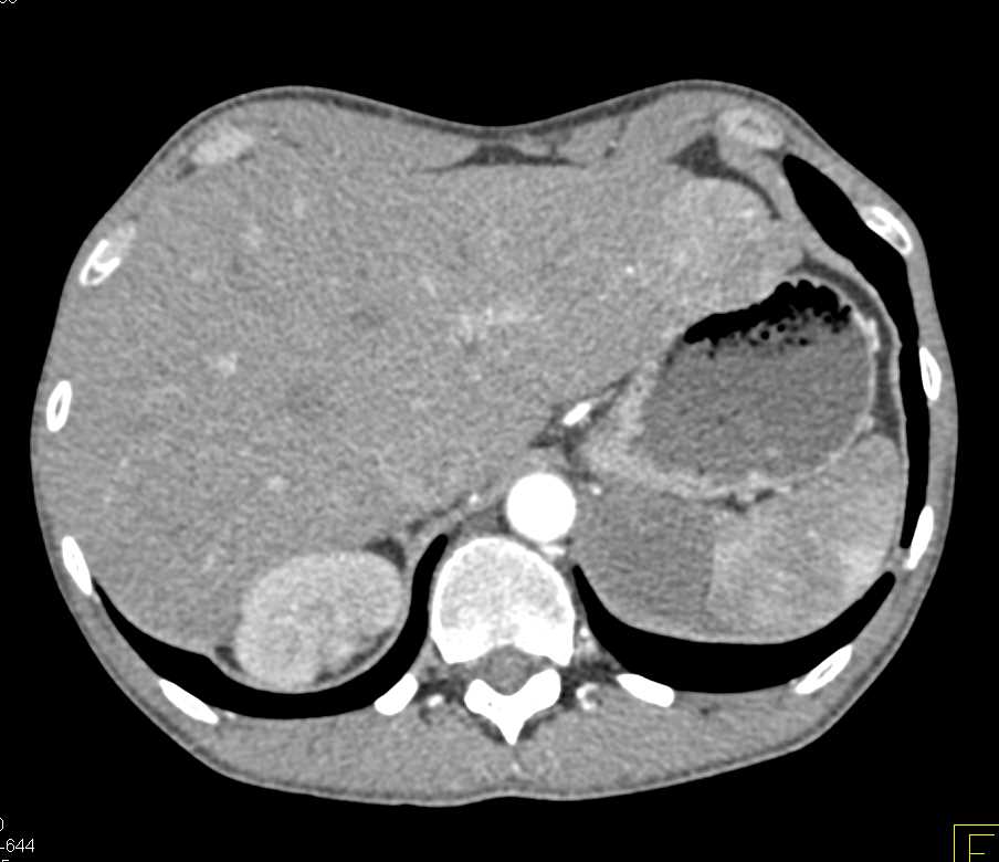 Recurrent Renal Cell Carcinoma with Bone and Adrenal Metastases - CTisus CT Scan