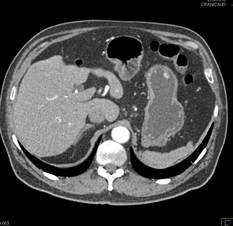 Metastatic Renal Cell Carcinoma to  Liver and Pancreas and Stomach - CTisus CT Scan