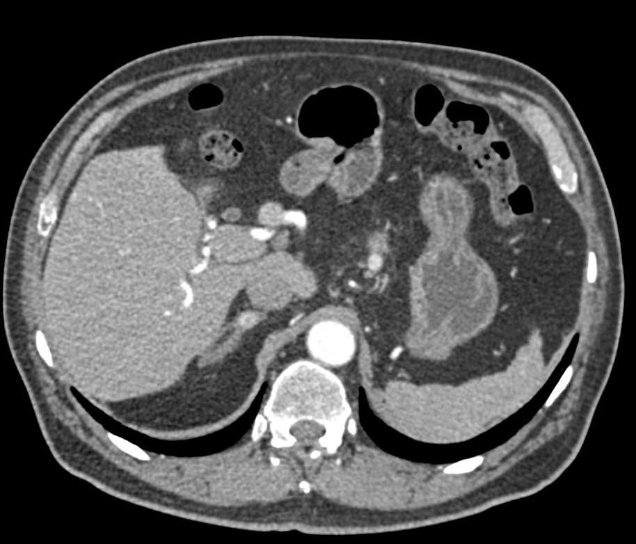 Metastatic Renal Cell Carcinoma to  Liver and Pancreas and Stomach - CTisus CT Scan