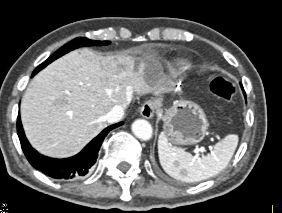 Metastatic Renal Cell Carcinoma to  Liver and Lungs and Spleen - CTisus CT Scan