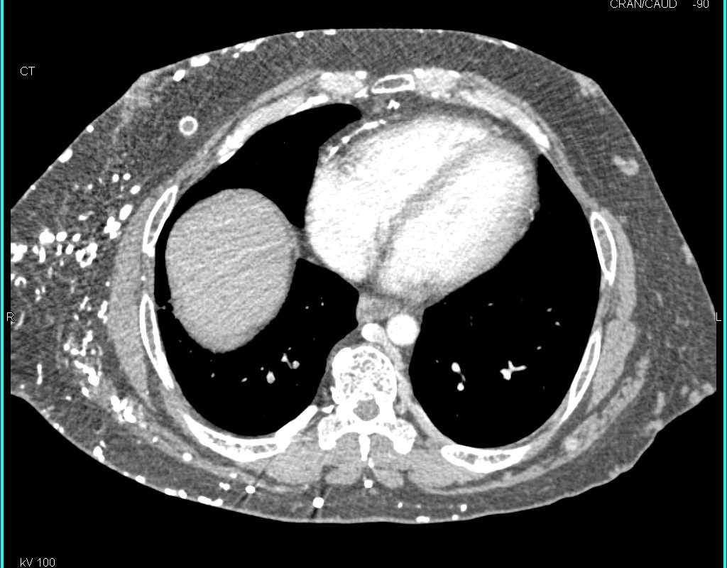 Arteriovenous (AV) Fistulae Left Thigh in a End Stage Renal Disease (ESRD) Patient - CTisus CT Scan