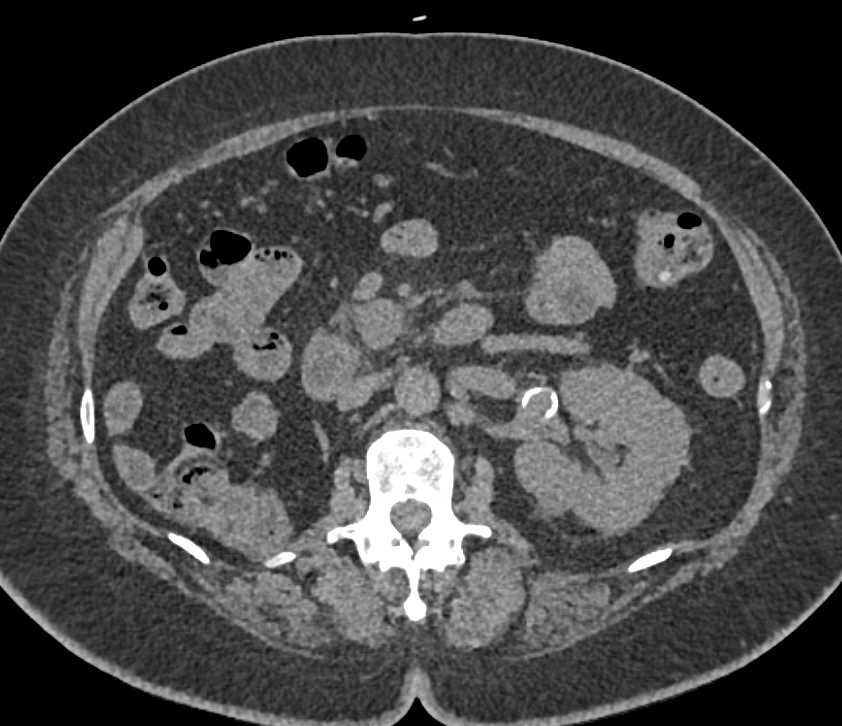 Recurrent Renal Cell Carcinoma with Pancreas, Adrenal and Liver Metastases - CTisus CT Scan