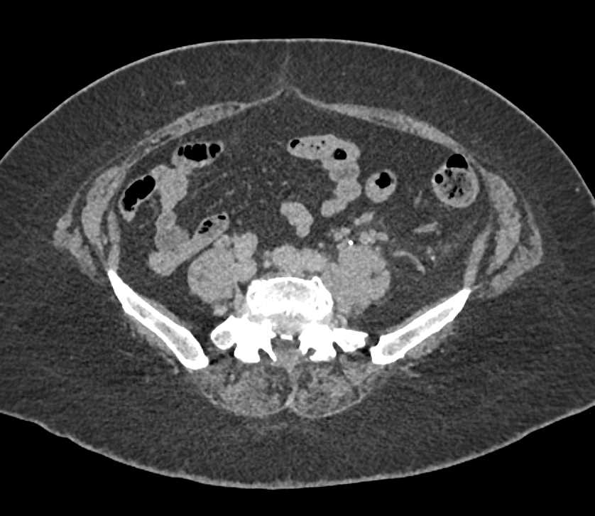 Recurrent Renal Cell Carcinoma with Pancreas, Adrenal, Renal and Liver Metastases - CTisus CT Scan