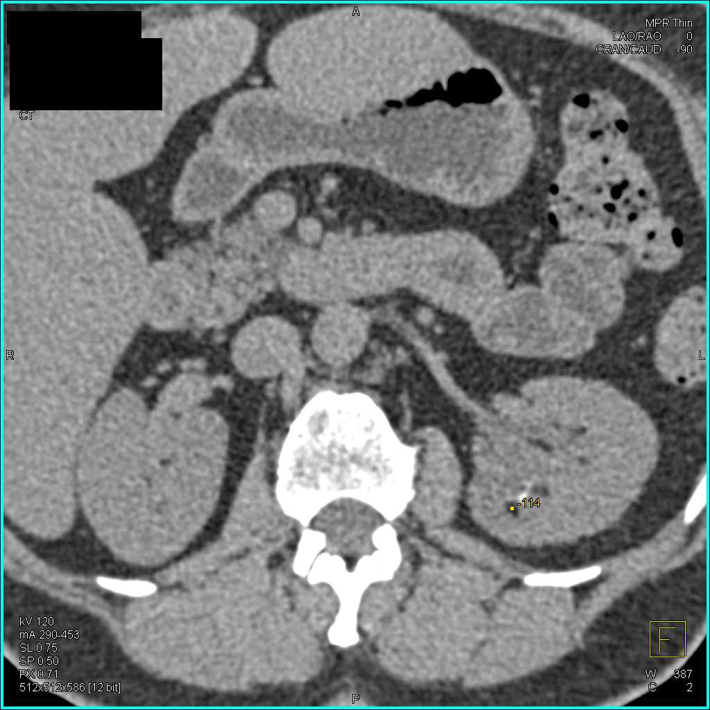 Left Renal Cell Carcinoma - Kidney Case Studies - CTisus CT Scanning