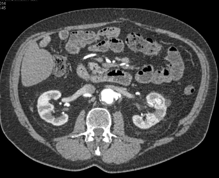 Incidental Left Renal Cell Carcinoma in Patient with Prostate Cancer - CTisus CT Scan