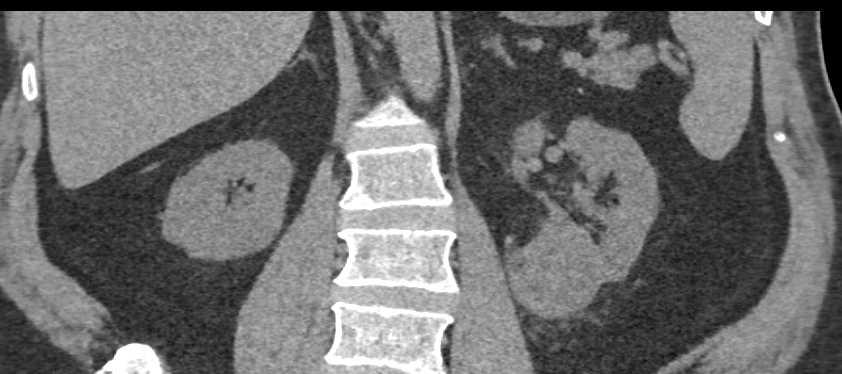 Clear Cell Left Renal Cell Carcinoma - CTisus CT Scan