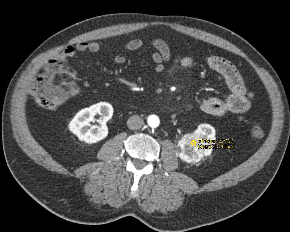 Clear Cell Left Renal Cell Carcinoma - CTisus CT Scan