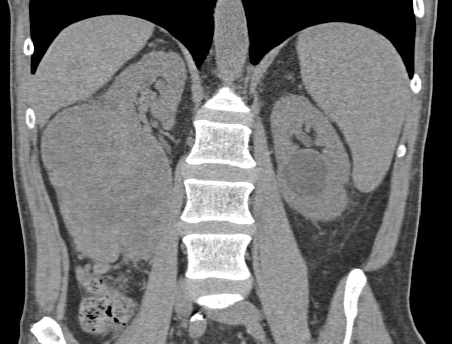 Necrotic 13 cm Right Renal Cell Carcinoma - CTisus CT Scan