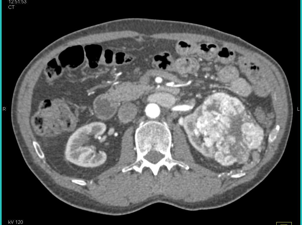 Clear Cell Renal Cell Carcinoma Left Kidney - CTisus CT Scan