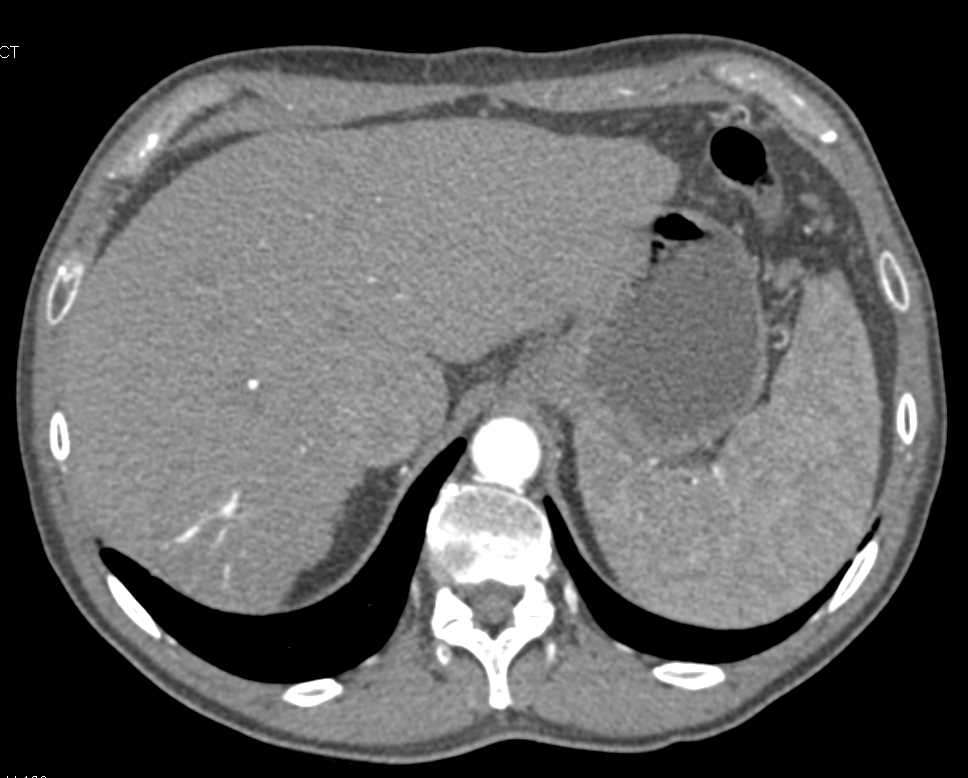 Clear Cell Renal Cell Carcinoma Left Kidney - CTisus CT Scan