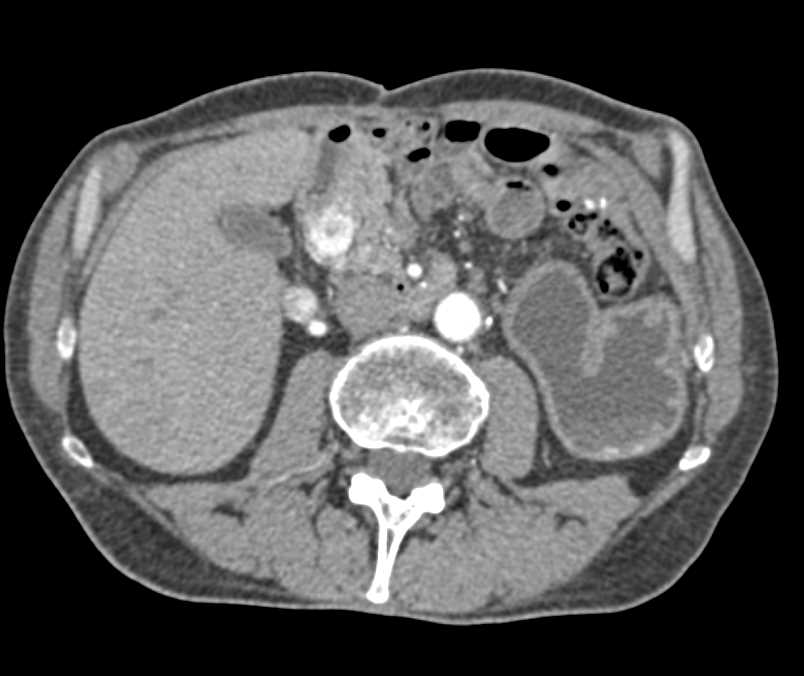 Metastatic Renal Cell Carcinoma to Contralateral Kidney and Pancreas - CTisus CT Scan