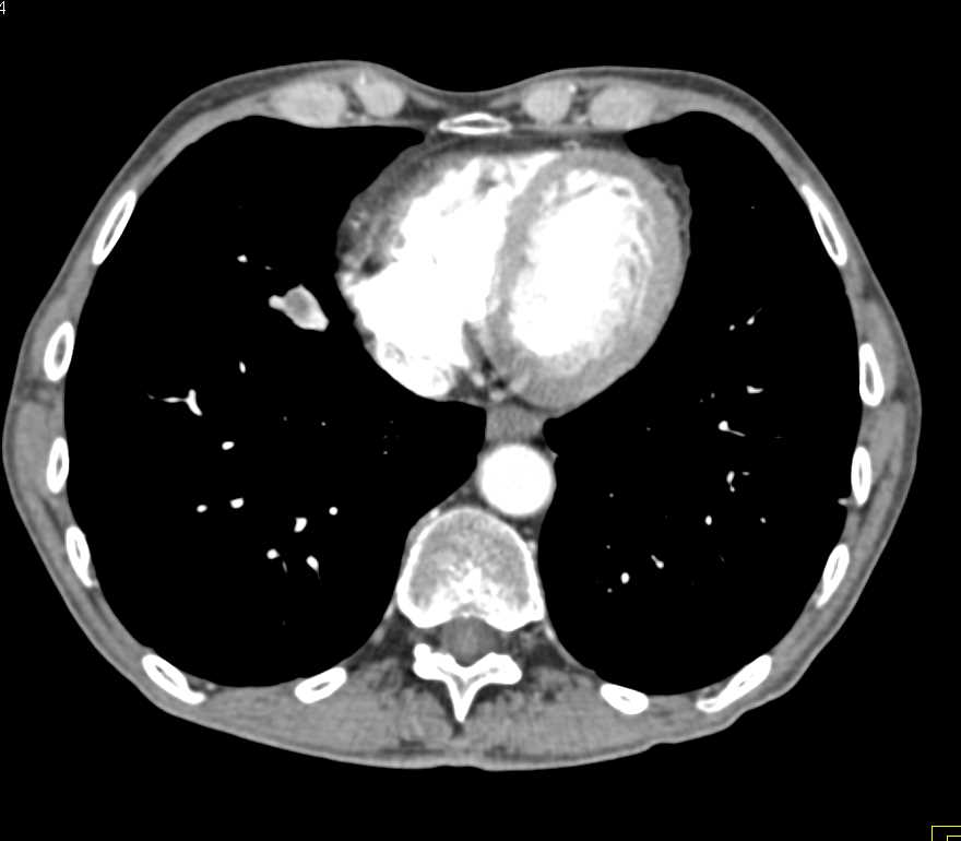 Metastatic Renal Cell Carcinoma to Contralateral Kidney and Pancreas and Bone - CTisus CT Scan