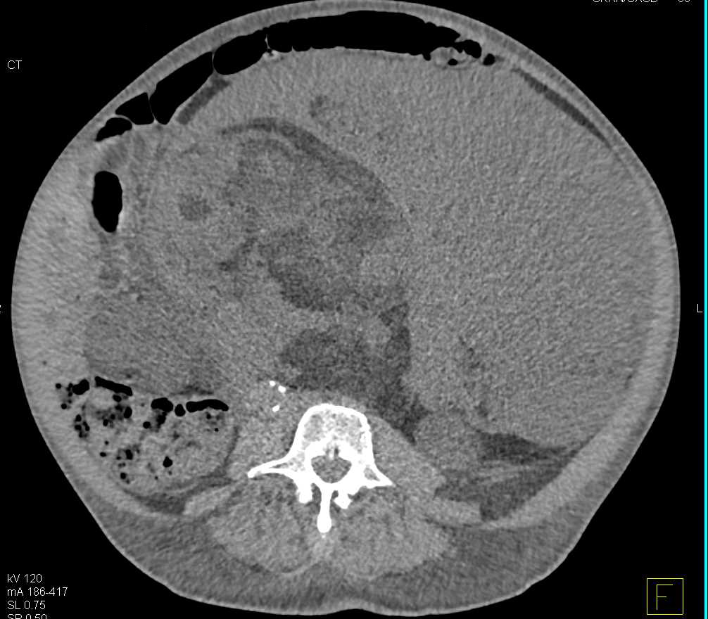 Renal Cell Carcinoma with Carcinomatosis - CTisus CT Scan