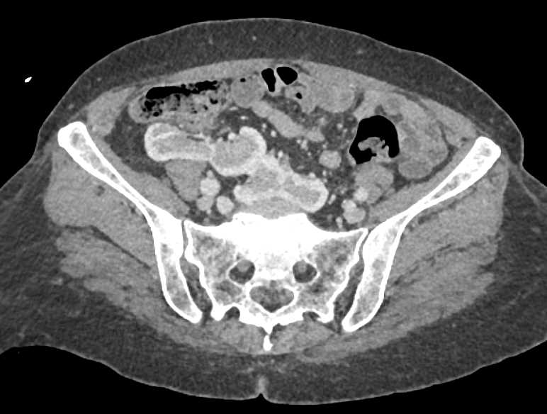 Pelvic Horseshoe Kidneys - CTisus CT Scan