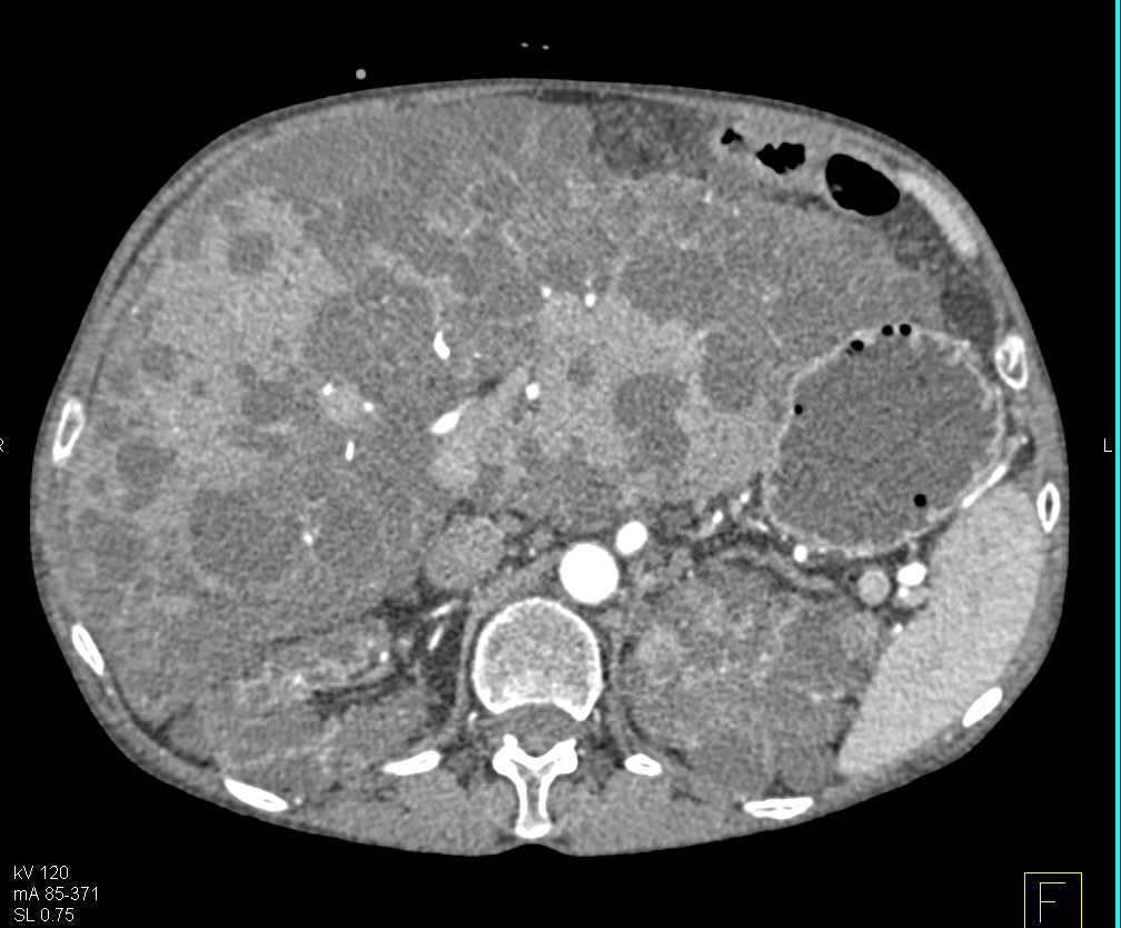 Polycystic Liver and Polycystic Kidney Disease - CTisus CT Scan