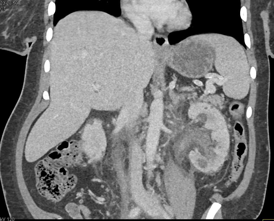 Pyelitis Involving Both Renal Pelvises and Ureters. Simulates a Transitional Cell Cancer (TCC) - CTisus CT Scan