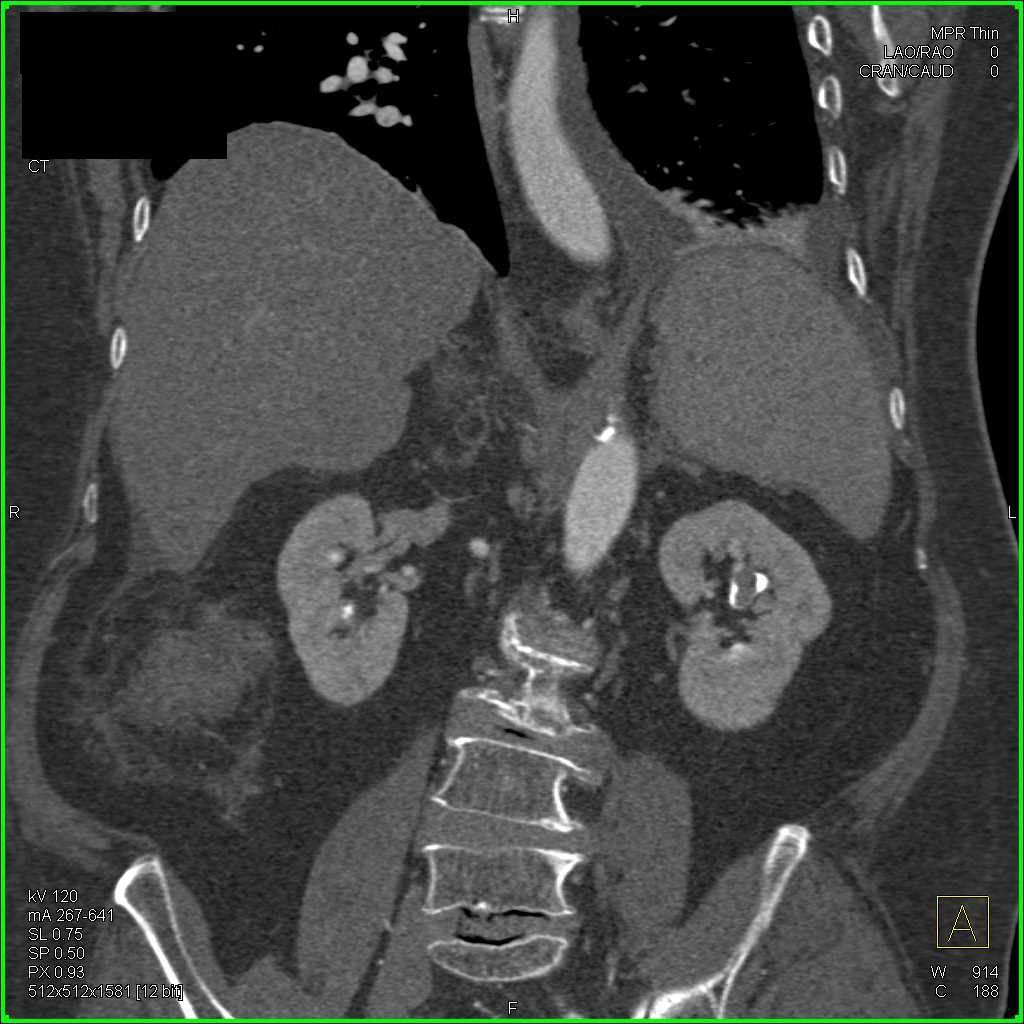 Transitional Cell Carcinoma Left Kidney - CTisus CT Scan