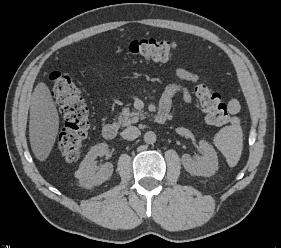 High Density Cyst Right Kidney in Multiple Phases - CTisus CT Scan