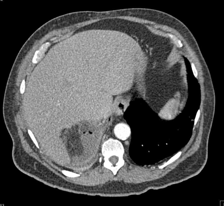 Post Resection Upper Pole of the Right Kidney with Hematoma - CTisus CT Scan