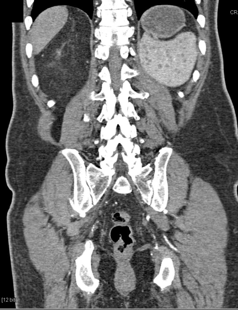 Metastatic Renal Cell Carcinoma to the Right Peri-renal Space - CTisus CT Scan