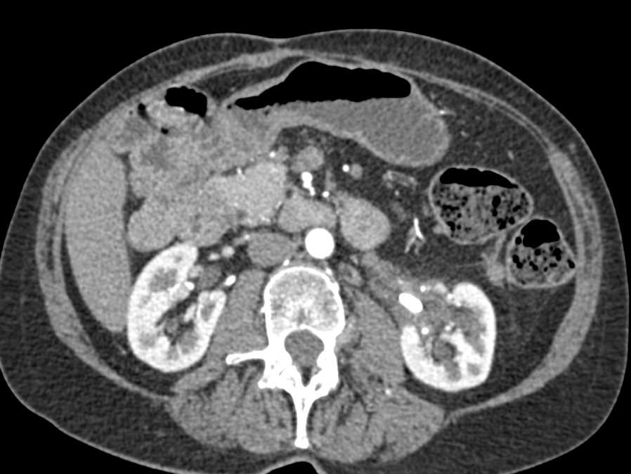 Stone in Inflamed Left Renal Pelvis with Dilated Ureter - CTisus CT Scan