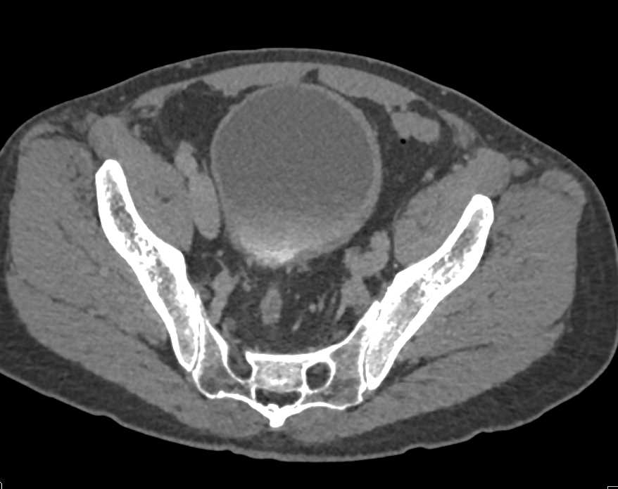 Transitional Cell Carcinoma of the Kidney with CT Urography - CTisus CT Scan