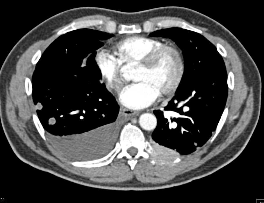 Recurrent Renal Cell Carcinoma with Metastases to Nodes, Muscle and Liver and Lung - CTisus CT Scan