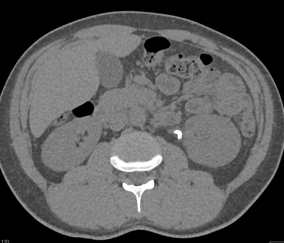 Acute Pyelonephritis Left Kidney with Obstructing Stone - CTisus CT Scan