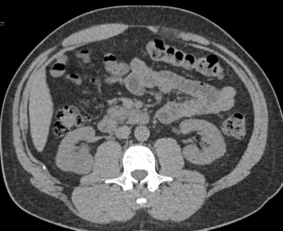 Papillary Renal Cell Carcinoma Right Kidney - CTisus CT Scan