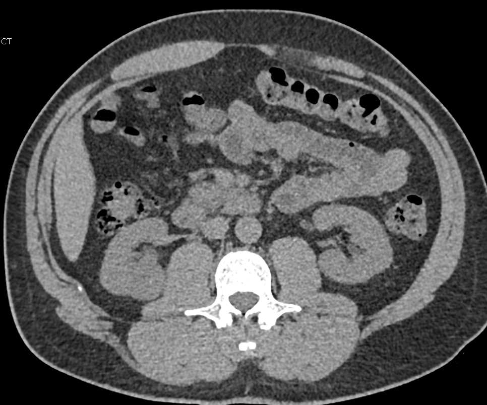 Papillary Renal Cell Carcinoma Right Kidney - CTisus CT Scan