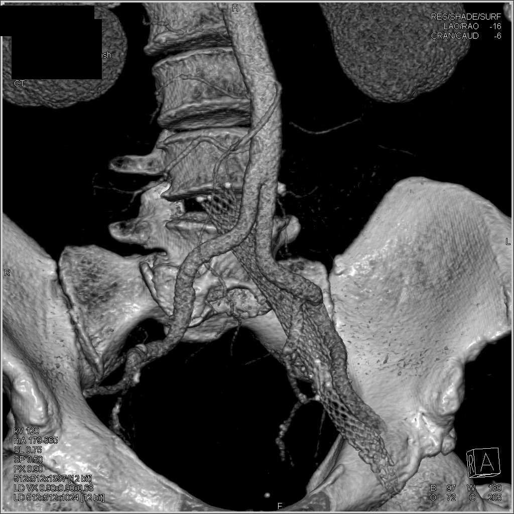 Infarction Left Kidney and Vascular Disease - CTisus CT Scan