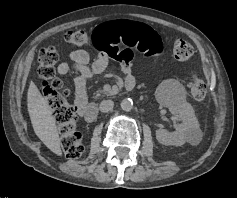 Right Renal Cell Carcinoma with Nephrectomy and Contralateral Metastases - CTisus CT Scan