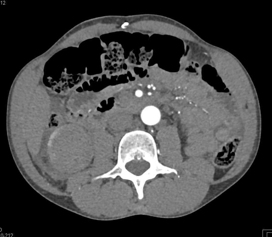 Papillary Renal Cell Carcinoma Right Kidney - CTisus CT Scan