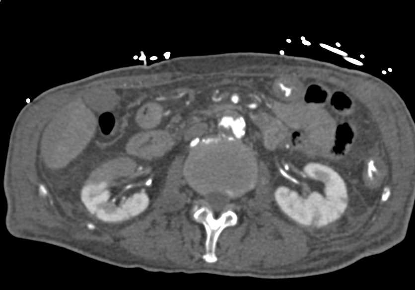 Renal Infarcts Right Kidney with Atherosclerotic Disease Aorta - CTisus CT Scan