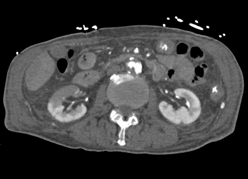 Renal Infarcts Right Kidney with Atherosclerotic Disease Aorta and Runoff Vessels - CTisus CT Scan