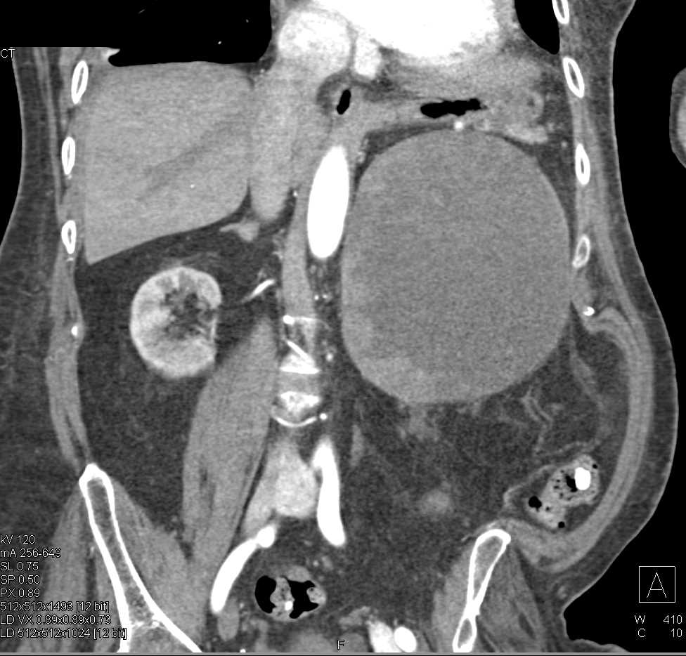 Cystic Left Renal Cell Carcinoma - CTisus CT Scan