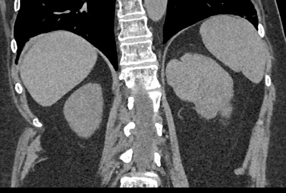 Papillary Left Renal Cell Carcinoma - CTisus CT Scan