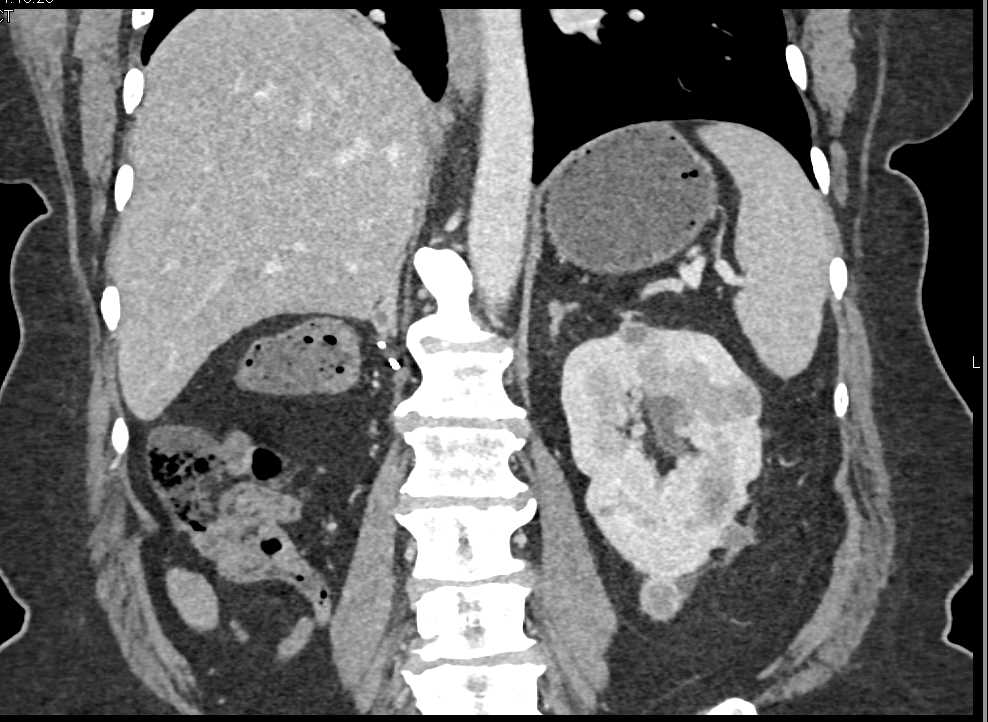 Metastatic Renal Cell Carcinoma to the Contralateral Kidney - CTisus CT Scan